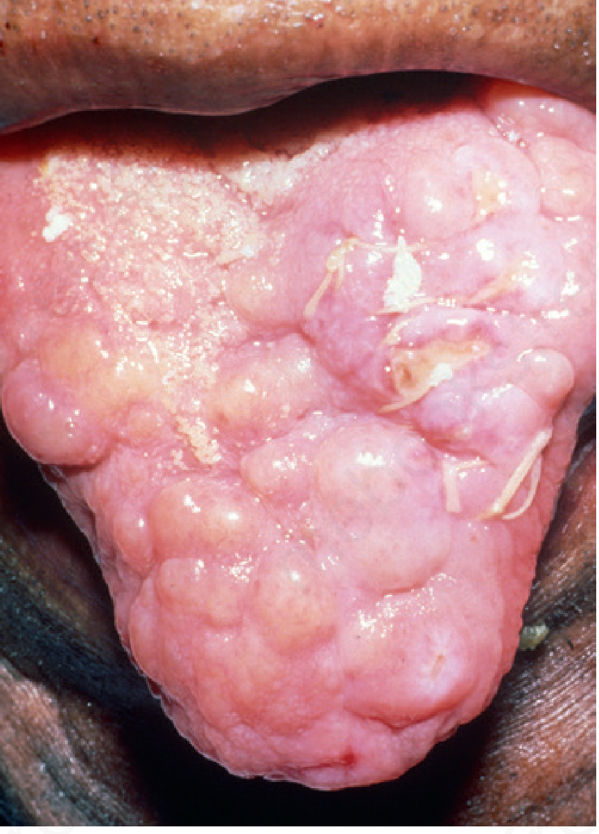 Macroglossia with nodular amyloid deposits on tongue surface (Andrews' Fig. 26.2)