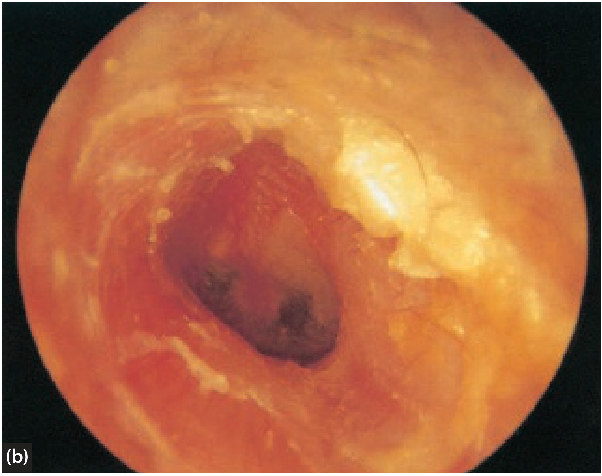 Otoscopic view of acute otitis externa showing oedematous canal skin with debris