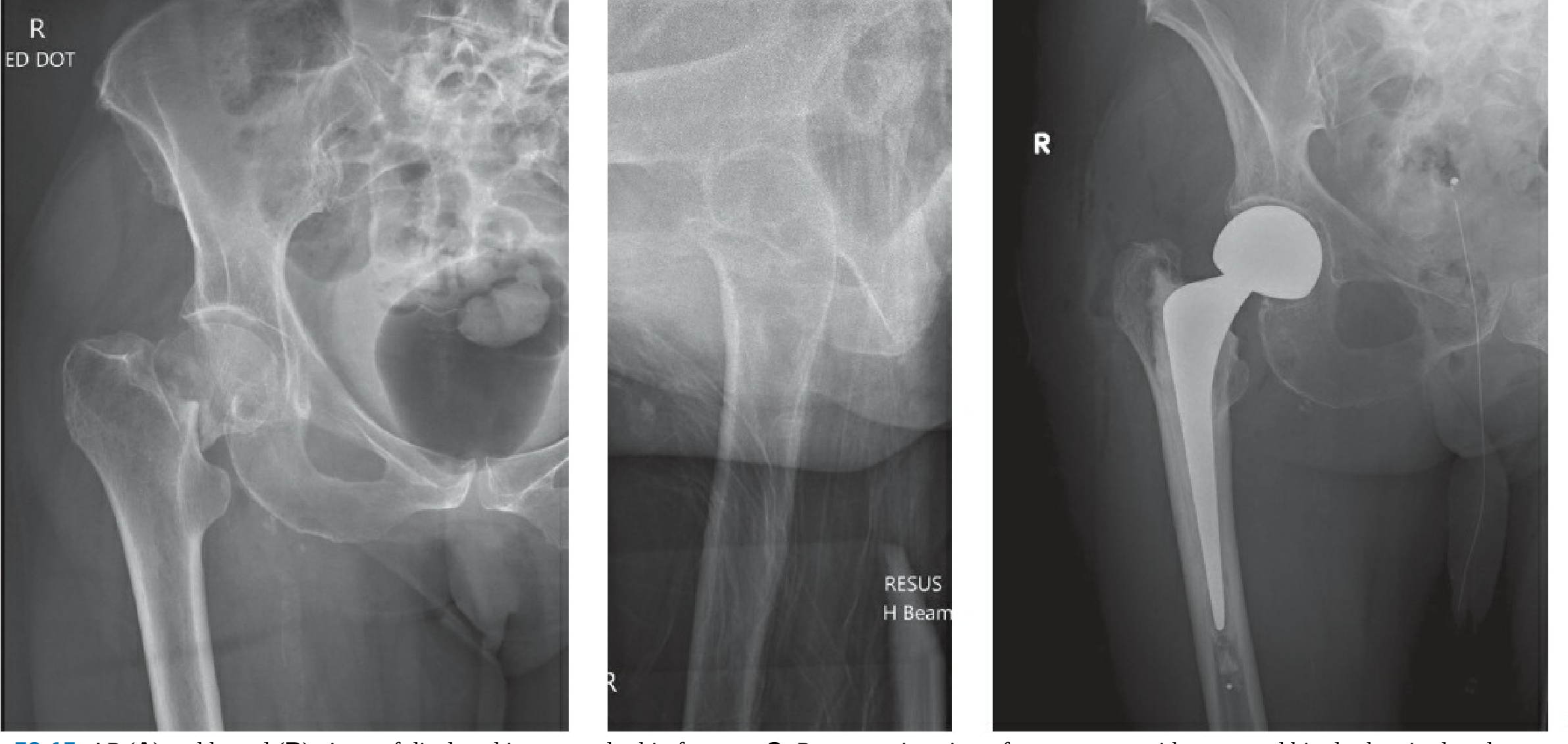 Pre-op AP and lateral views of displaced intracapsular hip fracture, and post-op AP view showing a well-positioned cemented bipolar hemiarthroplasty