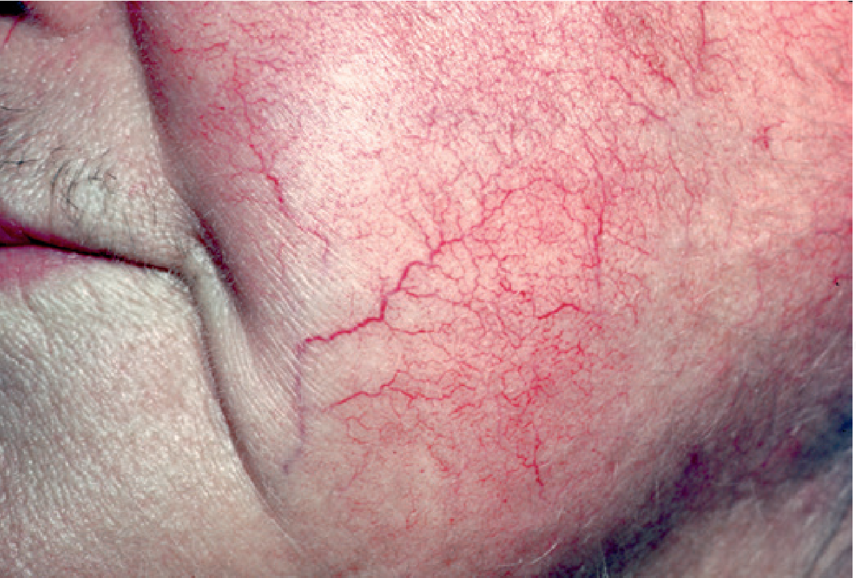 Topical steroid-induced atrophy - prominent telangiectasias on facial skin