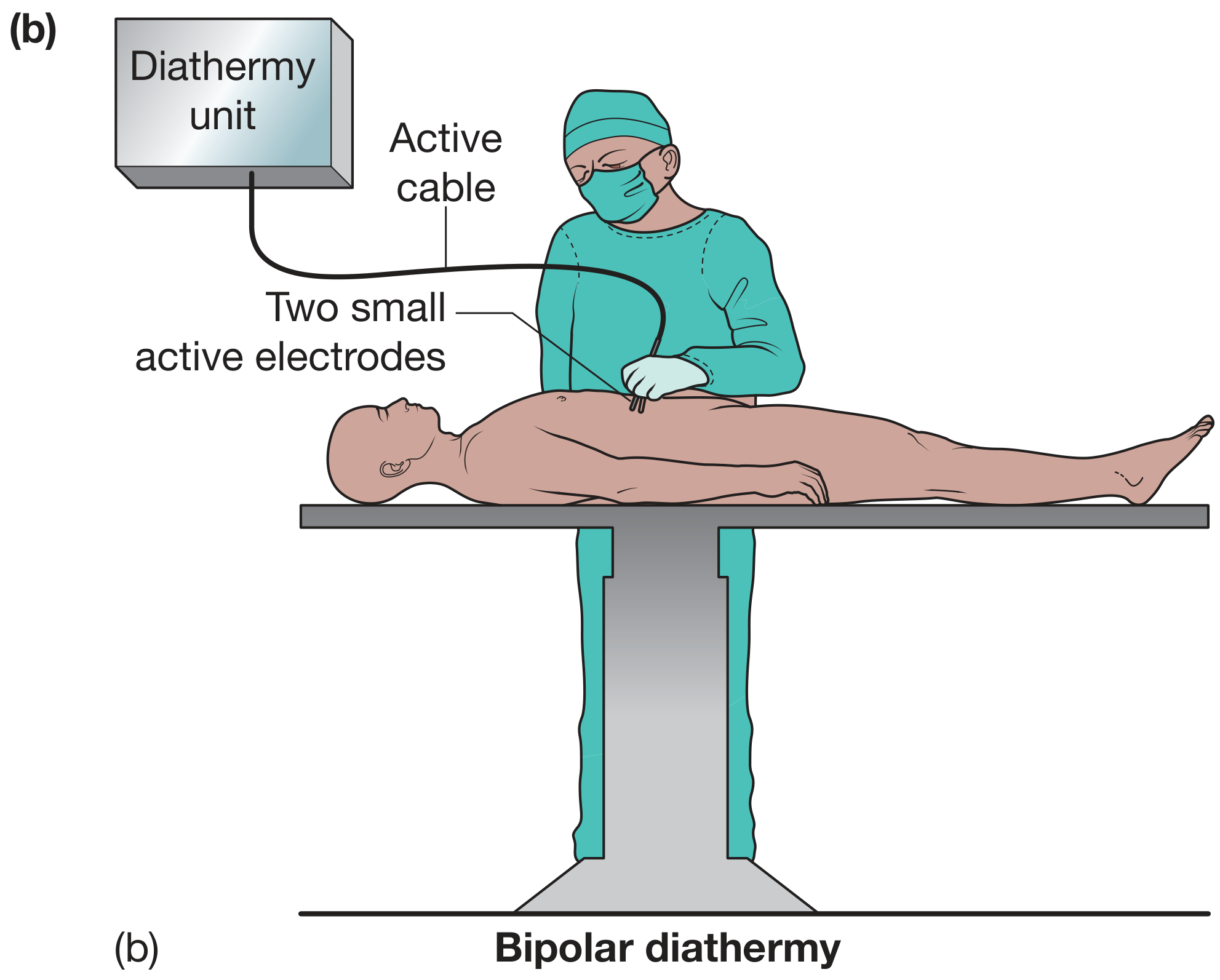 Bipolar diathermy setup showing diathermy unit, active cable and two small active electrodes at the forceps tips