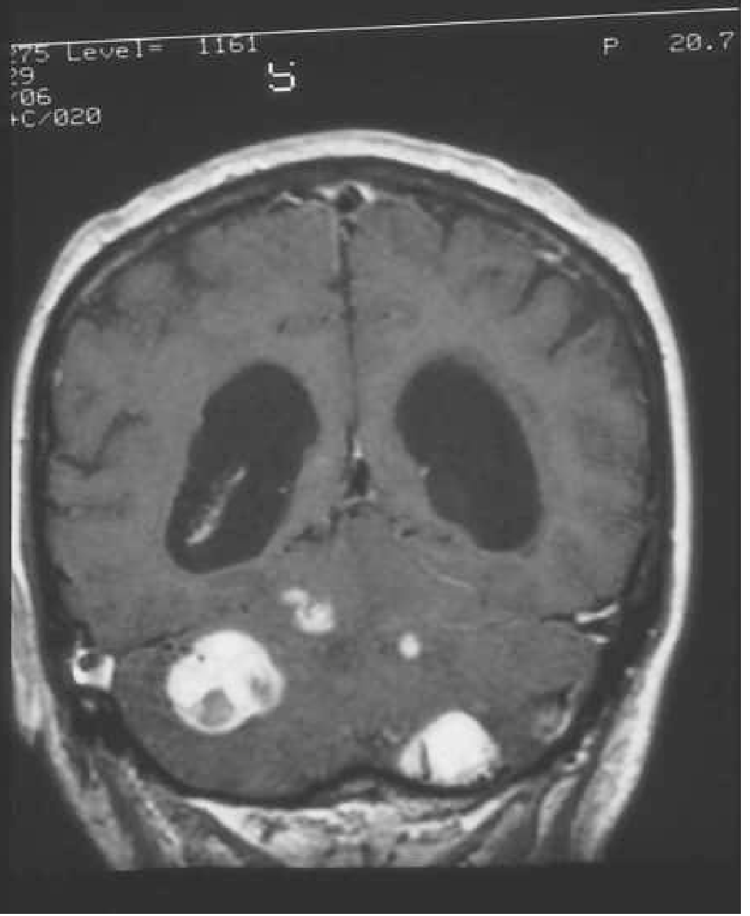 MRI showing multiple cerebellar hemangioblastomas in VHL syndrome