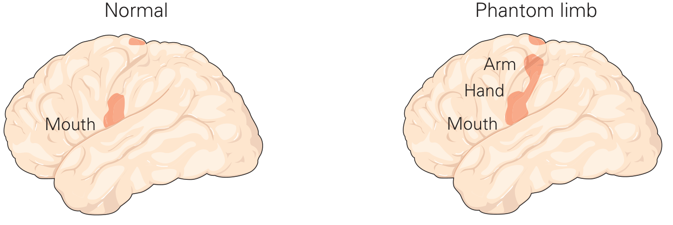Somatosensory cortical reorganization in phantom limb. In the phantom limb state, the mouth's cortical representation expands into the arm/hand area.