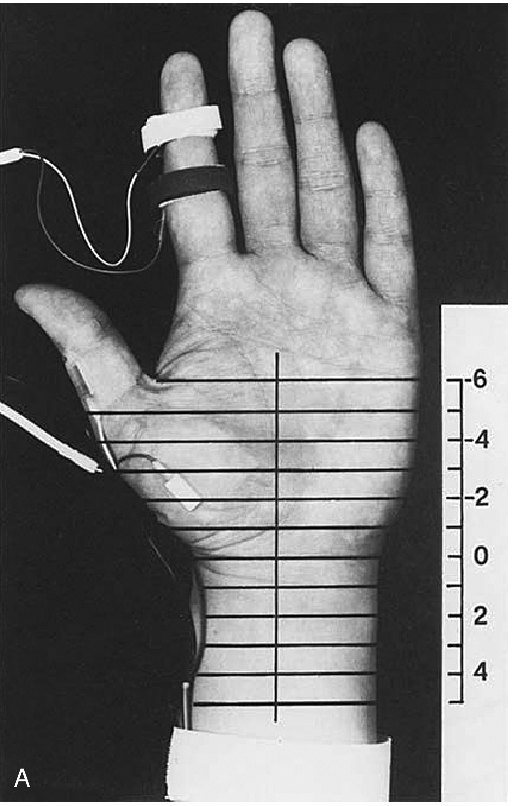Inching technique: palm of hand with 12 stimulation sites marked in 1-cm increments across the wrist. Reference point (0) = distal wrist crease = origin of transverse carpal ligament