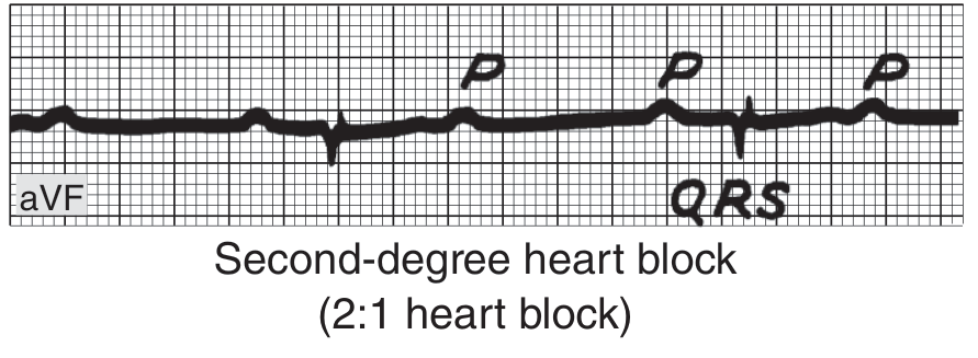 Second-degree 2:1 heart block showing every other P wave fails to conduct