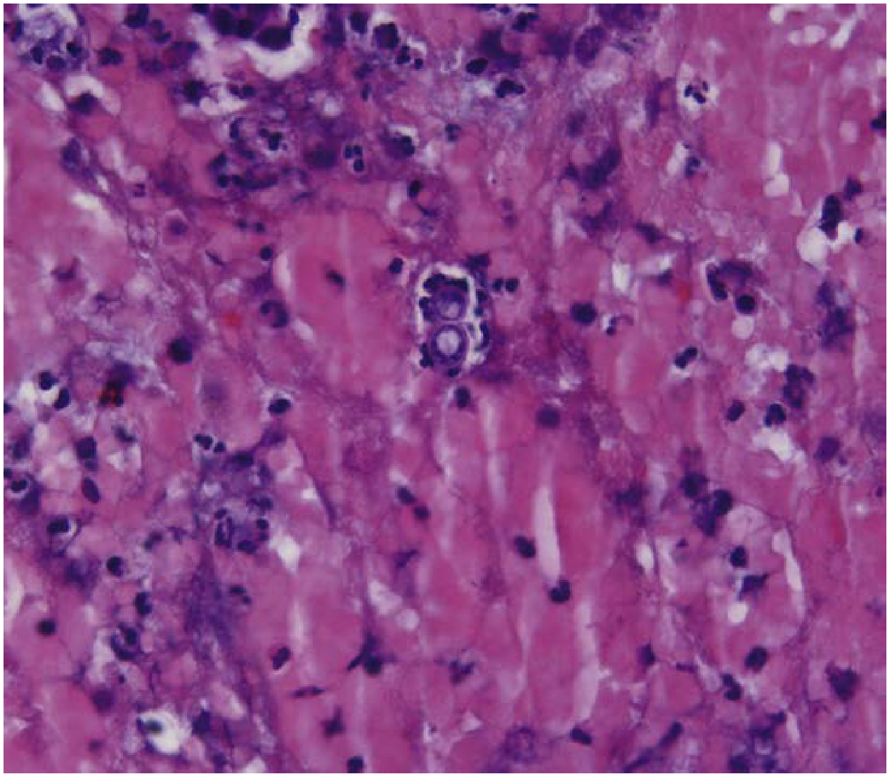 Blastomyces dermatitidis in tissue showing characteristic large, broad-based, budding yeast cells with thick refractile double-contoured wall (H&E stain, 400x)