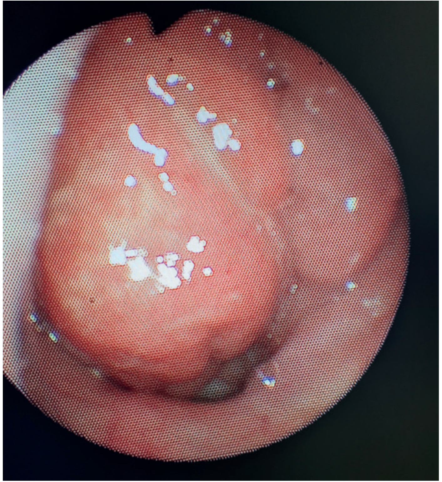 Endoscopic view of adenoid hypertrophy showing enlarged pinkish-red adenoid tissue