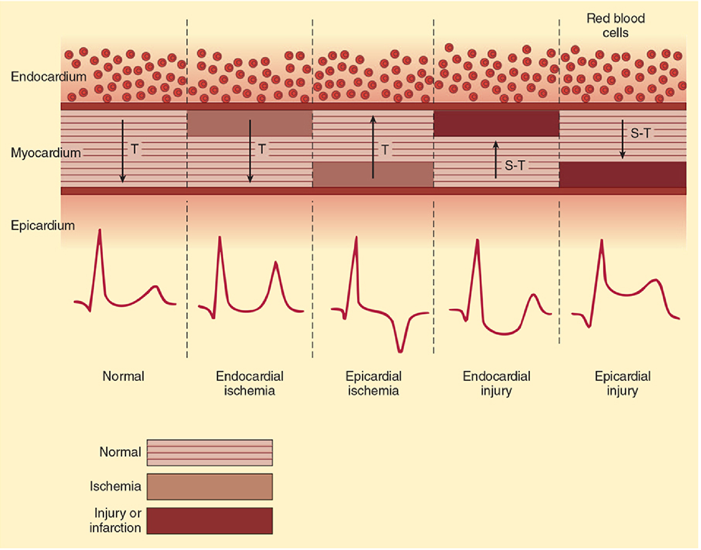 ECG signs of ischemia and injury by myocardial layer