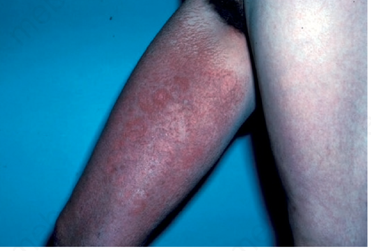 CRPS skin changes lower leg