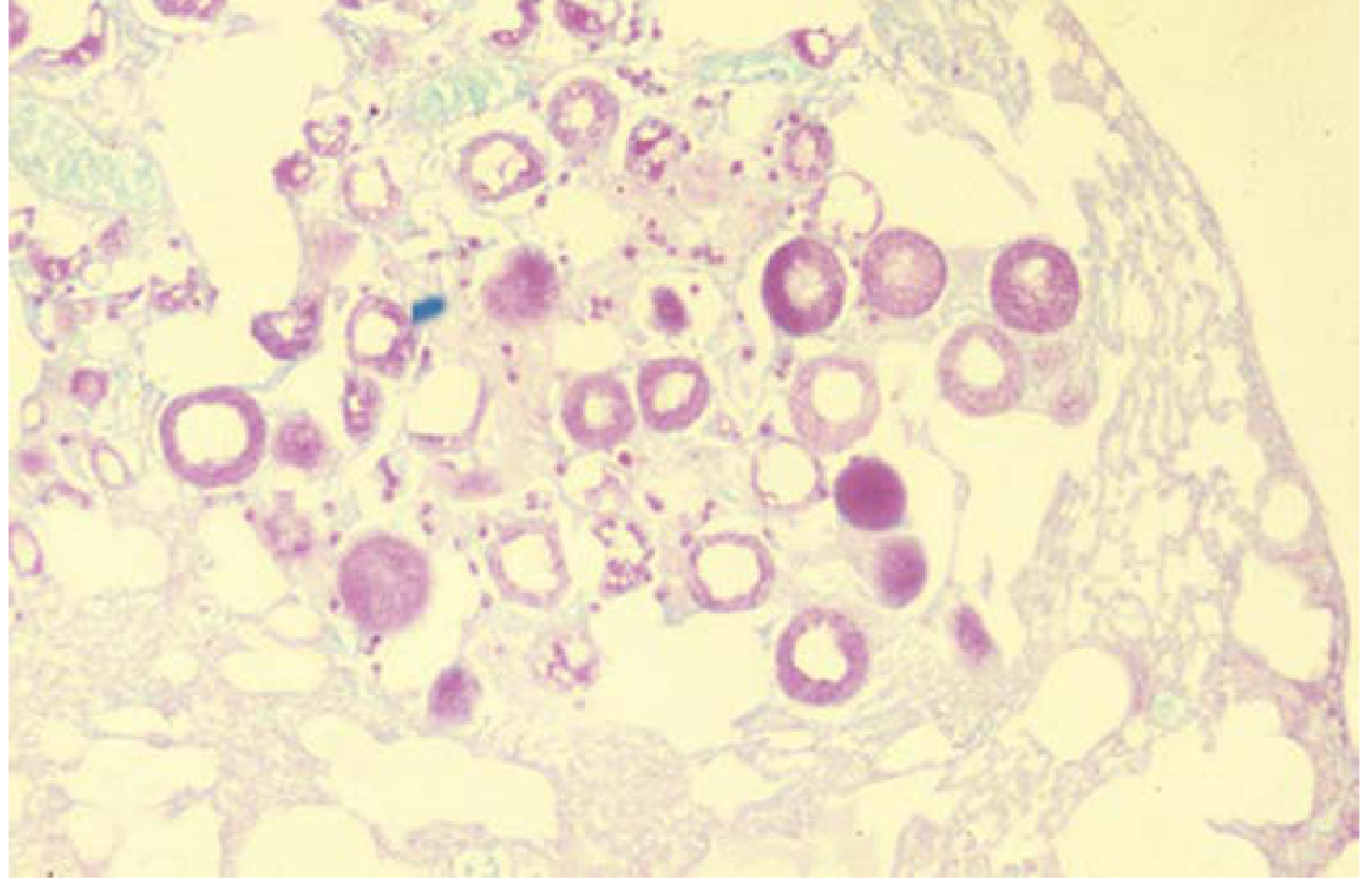 Spherules of Coccidioides spp. in tissue - large structures presumptive of coccidioidomycosis (H&E stain, 100x)