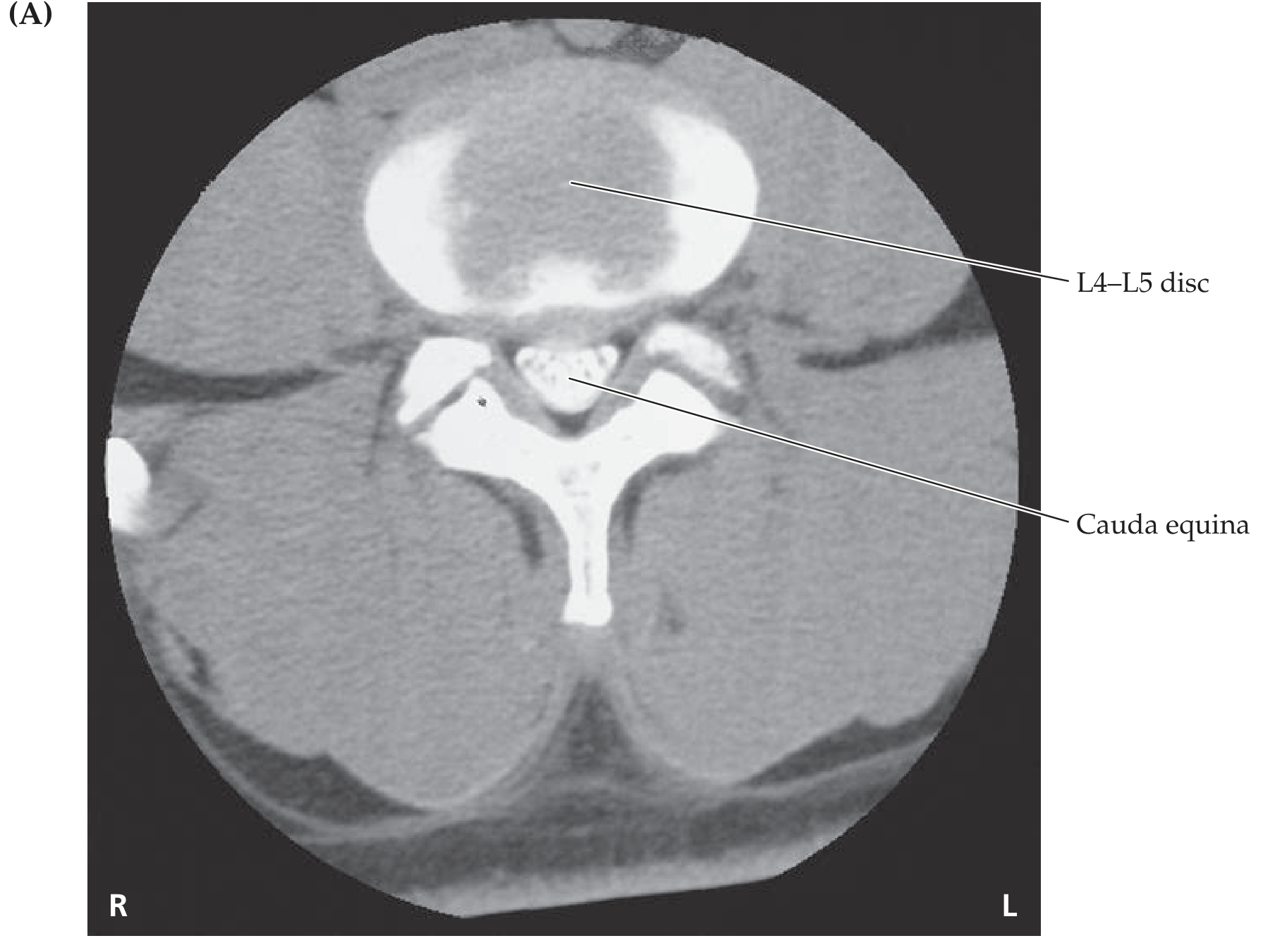 L4-L5 level showing normal cauda equina
