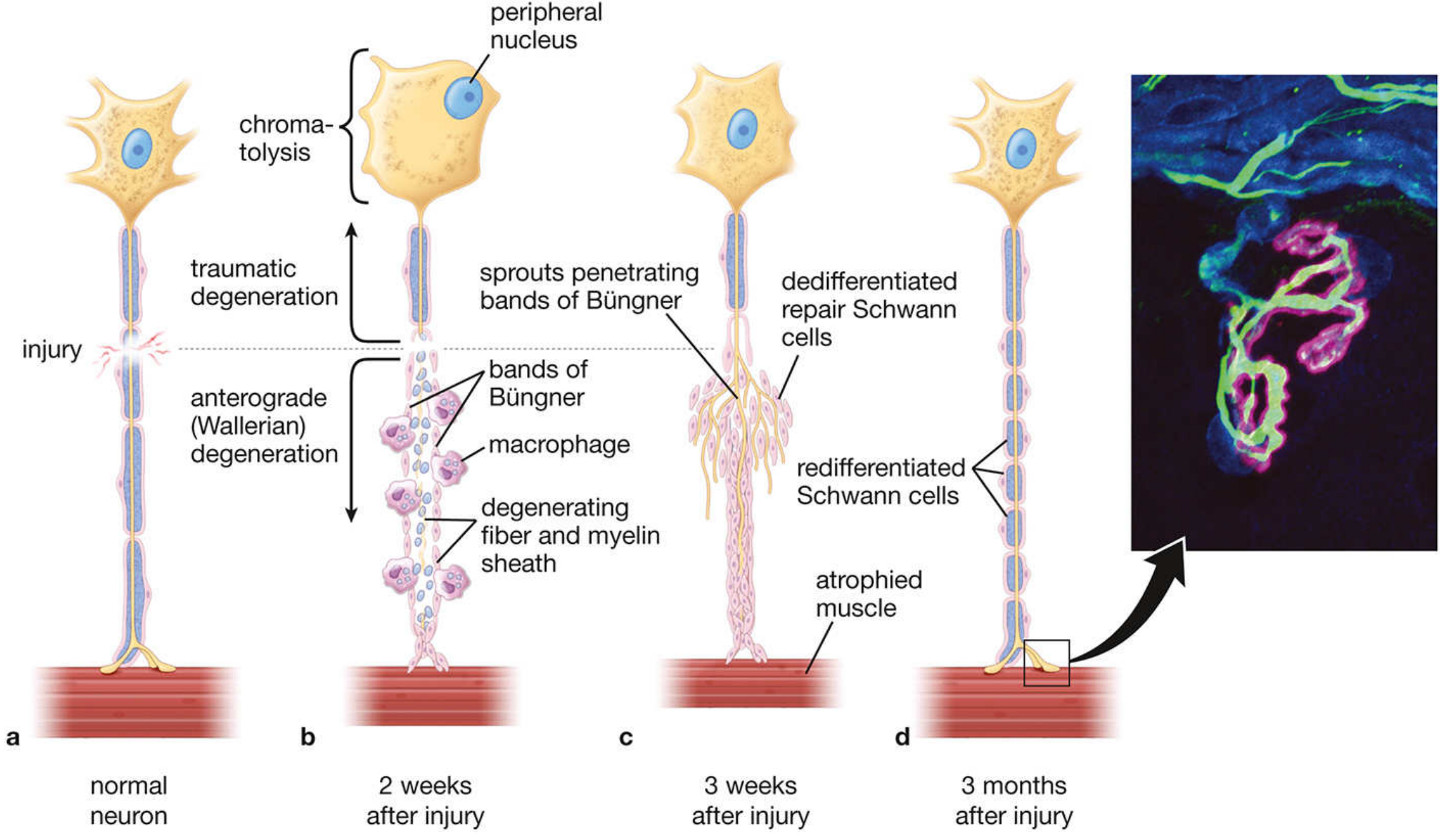 Wallerian degeneration sequence: a=normal neuron; b=2 weeks after injury - anterograde (Wallerian) degeneration distal, traumatic degeneration proximal, chromatolysis in cell body, bands of Büngner with macrophages; c=3 weeks - axonal sprouts penetrate bands of Büngner, muscle atrophied; d=3 months - successful reinnervation with redifferentiated Schwann cells