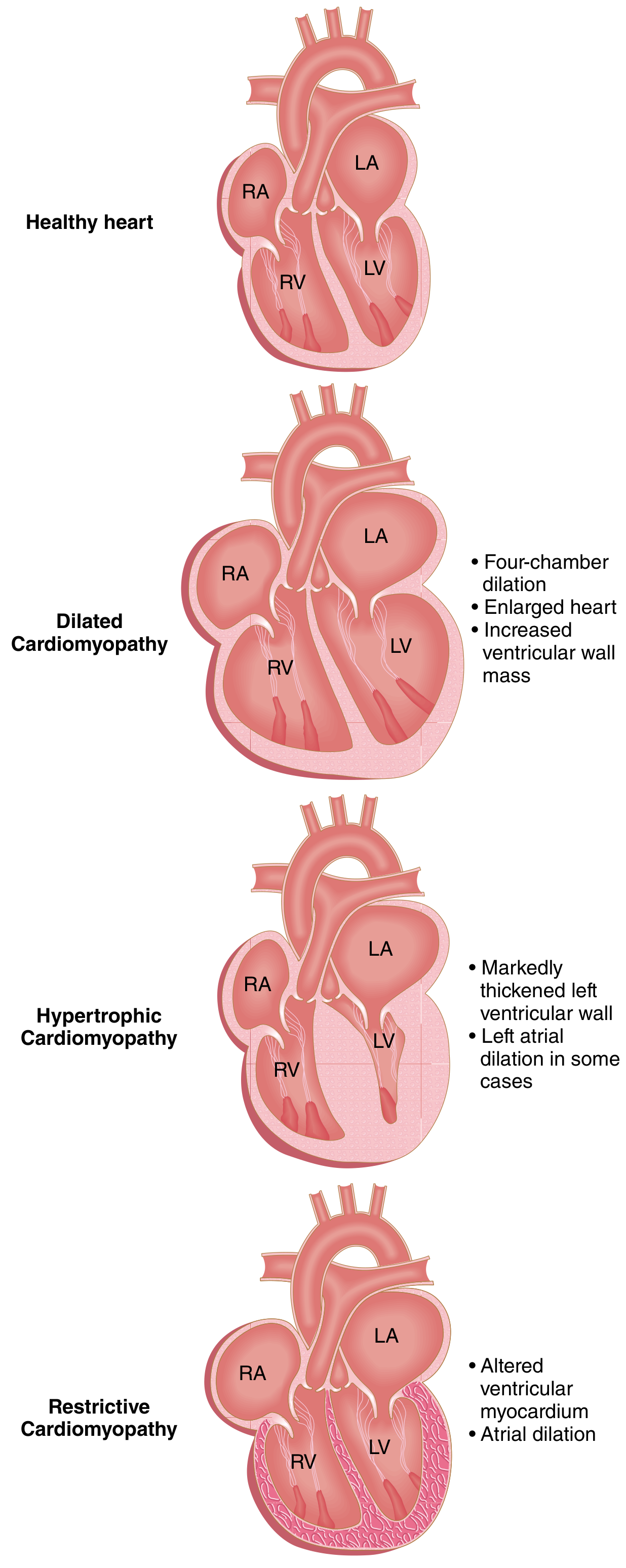 Three cardiomyopathy patterns: Dilated (4-chamber dilation), Hypertrophic (thick LV wall, small cavity), Restrictive (altered ventricular myocardium, atrial dilation)