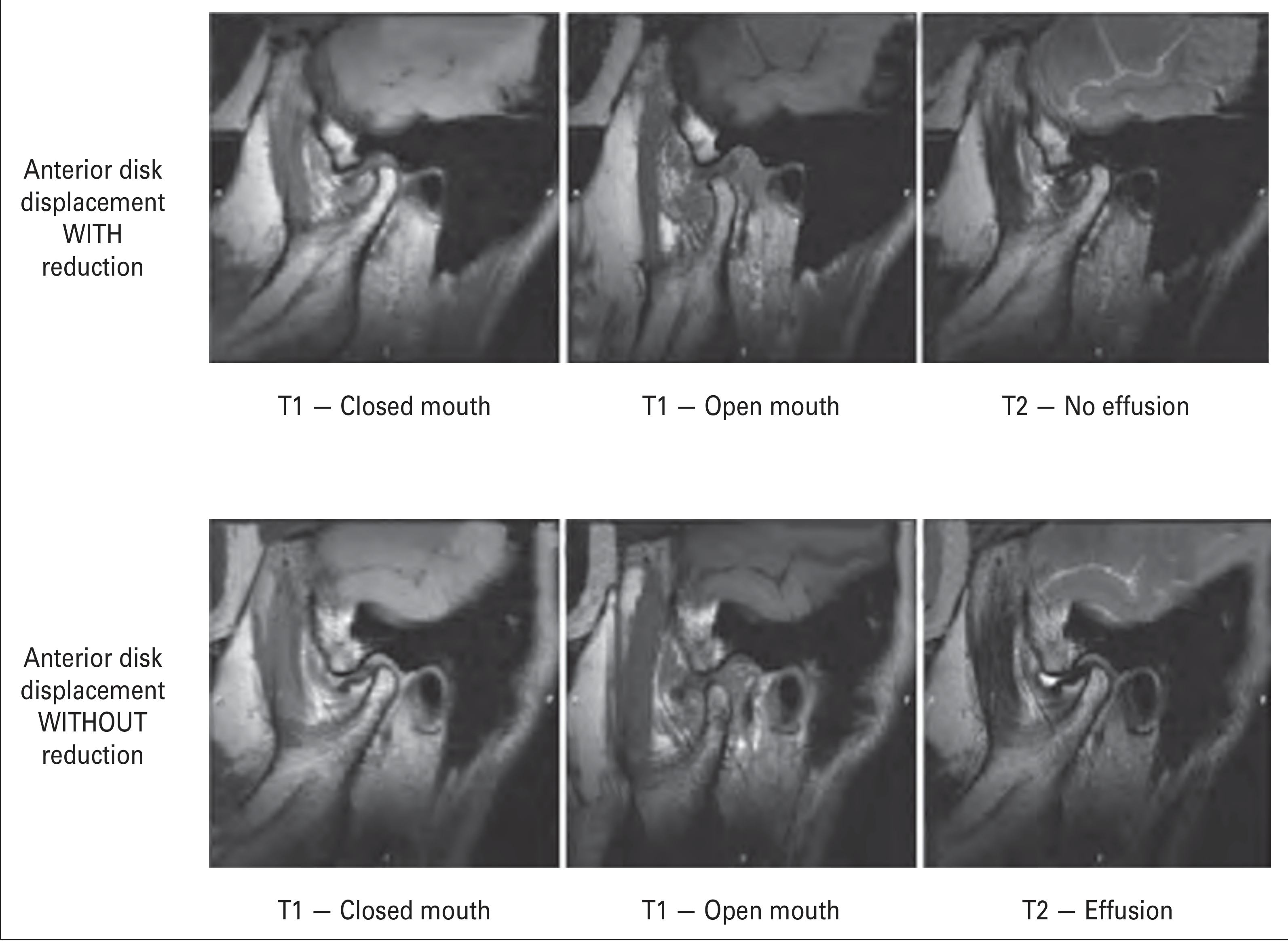MRI showing anterior disc displacement with reduction (top row) vs. without reduction (bottom row), with and without joint effusion