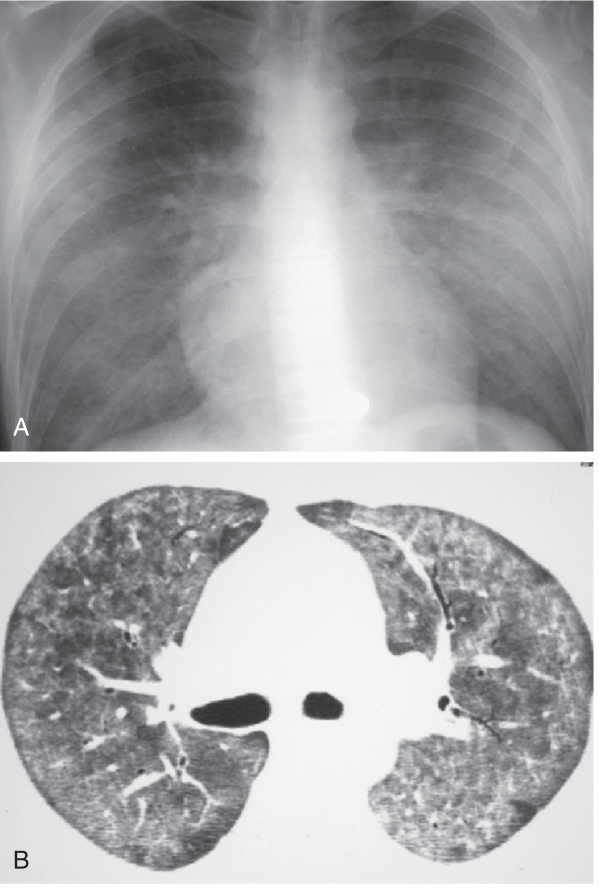 Typical PCP CXR