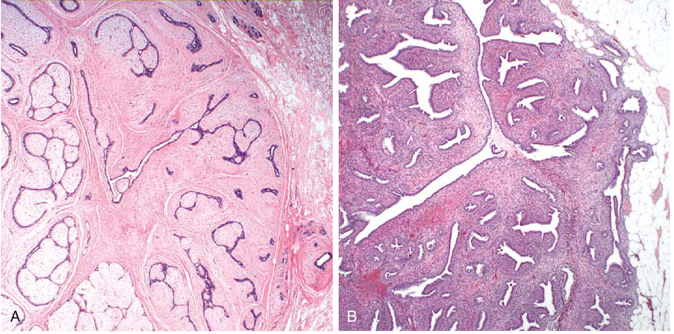 Intralobular stromal neoplasms: fibroadenoma and phyllodes tumor histology