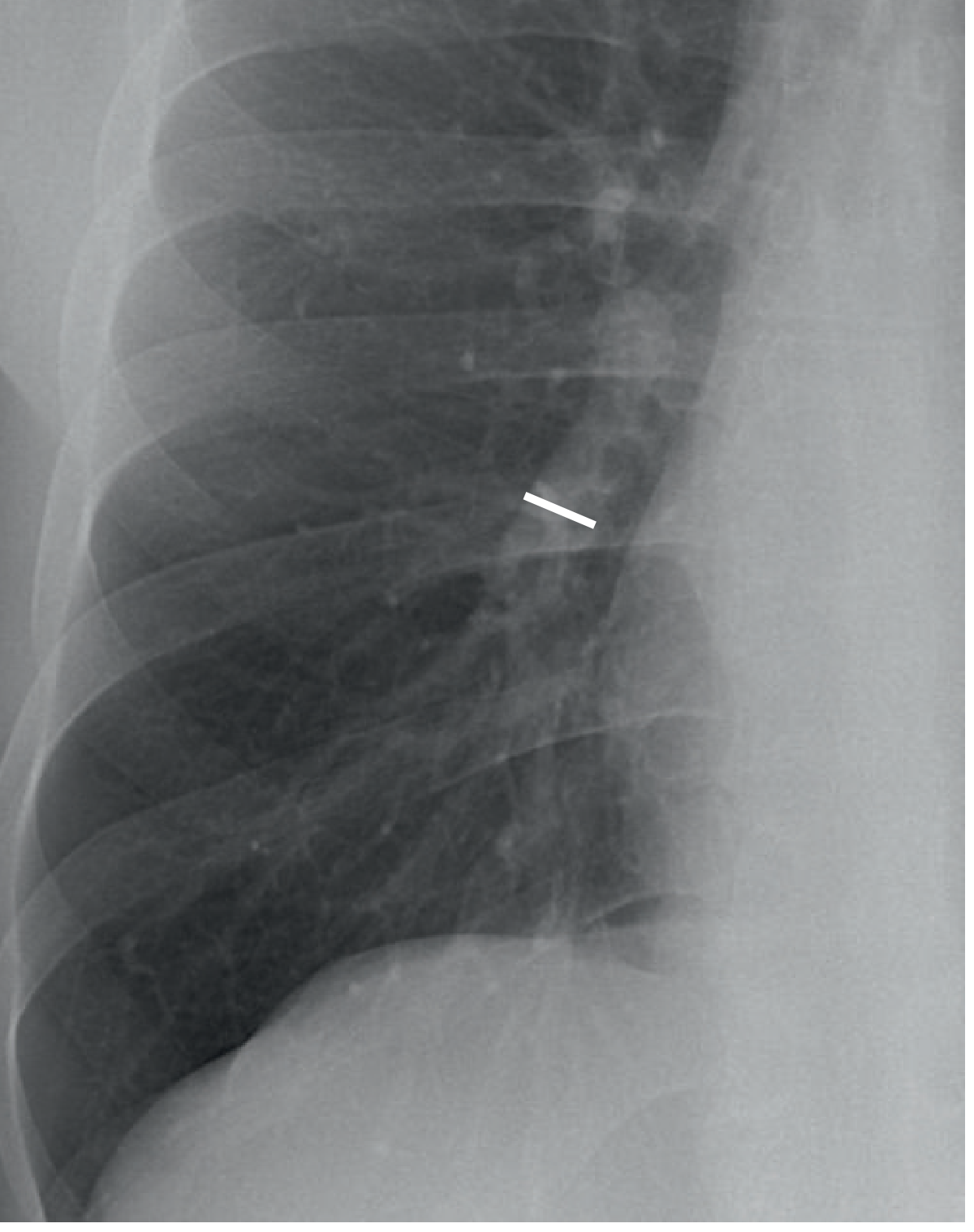 Frontal Hila with lower lobe artery measurement points - Grainger & Allison's