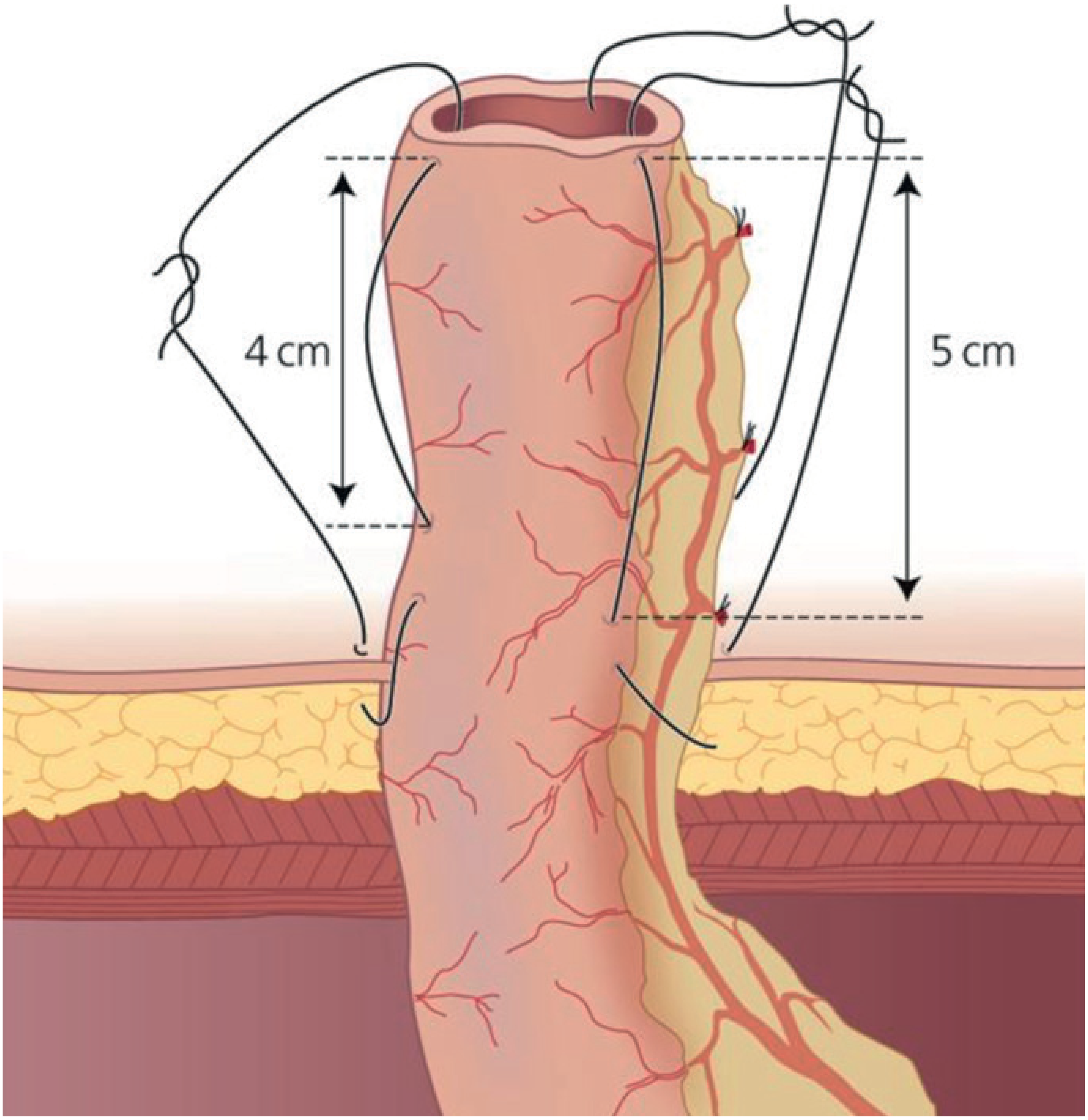 Construction of end-ileostomy showing the spout: 4 cm of bowel above the fascia creates a 2 cm spout above skin after eversion - Bailey and Love's 28th ed.