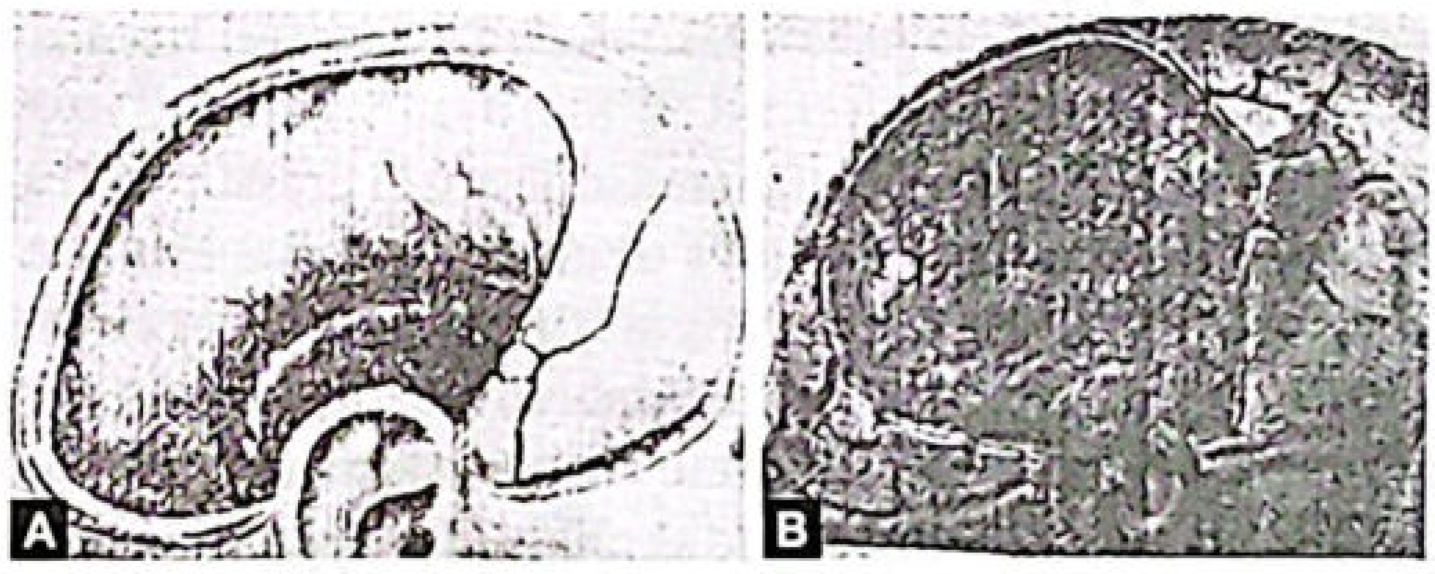 Comparison of extradural hemorrhage (A) vs heat hematoma with honeycomb pattern (B)