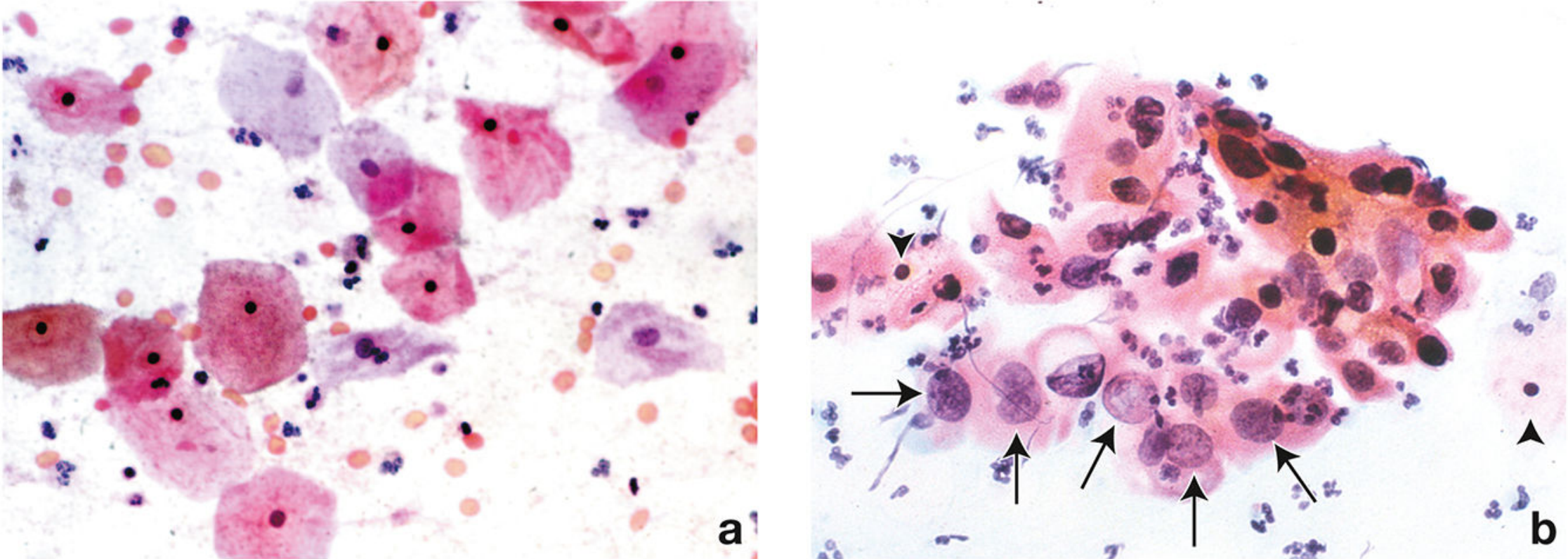 Pap stain - Normal (a) vs Abnormal (b) cervical cytology