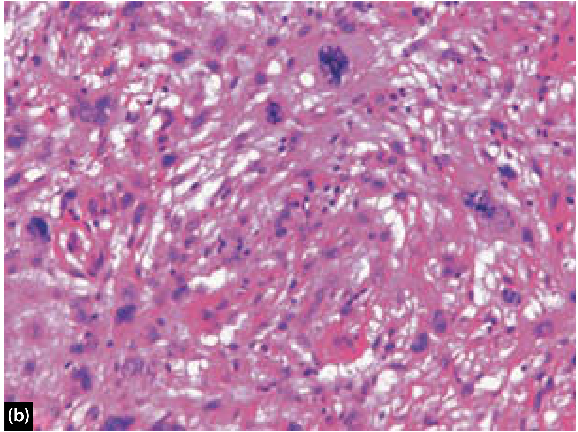 Spindle Cell Carcinoma of Larynx - H&E, high magnification showing highly pleomorphic spindle and bizarre giant cells with abnormal mitoses, reminiscent of undifferentiated pleomorphic sarcoma (Scott-Brown's ORL H&N Surgery)
