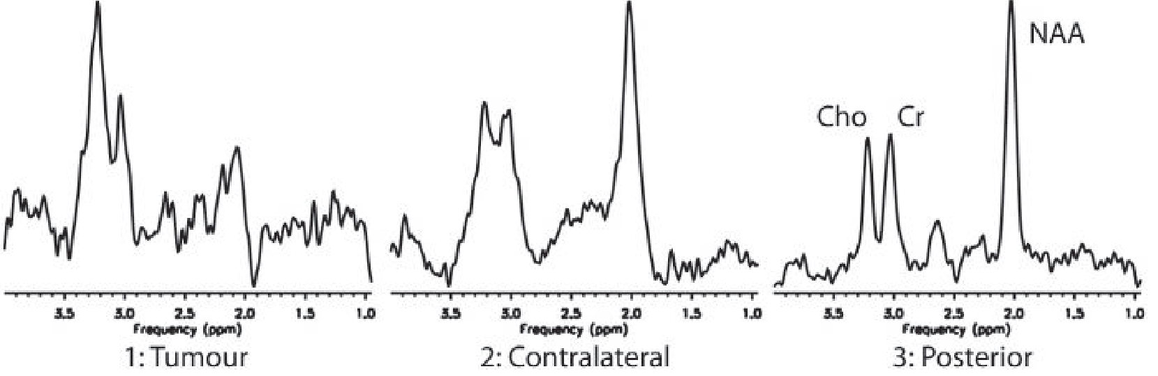 MRS spectra from low-grade glioma patient: (1) Tumour voxel - dominant Cho peak, absent NAA; (2) Contralateral normal brain; (3) Posterior normal brain showing Cho, Cr, NAA peaks in normal proportions