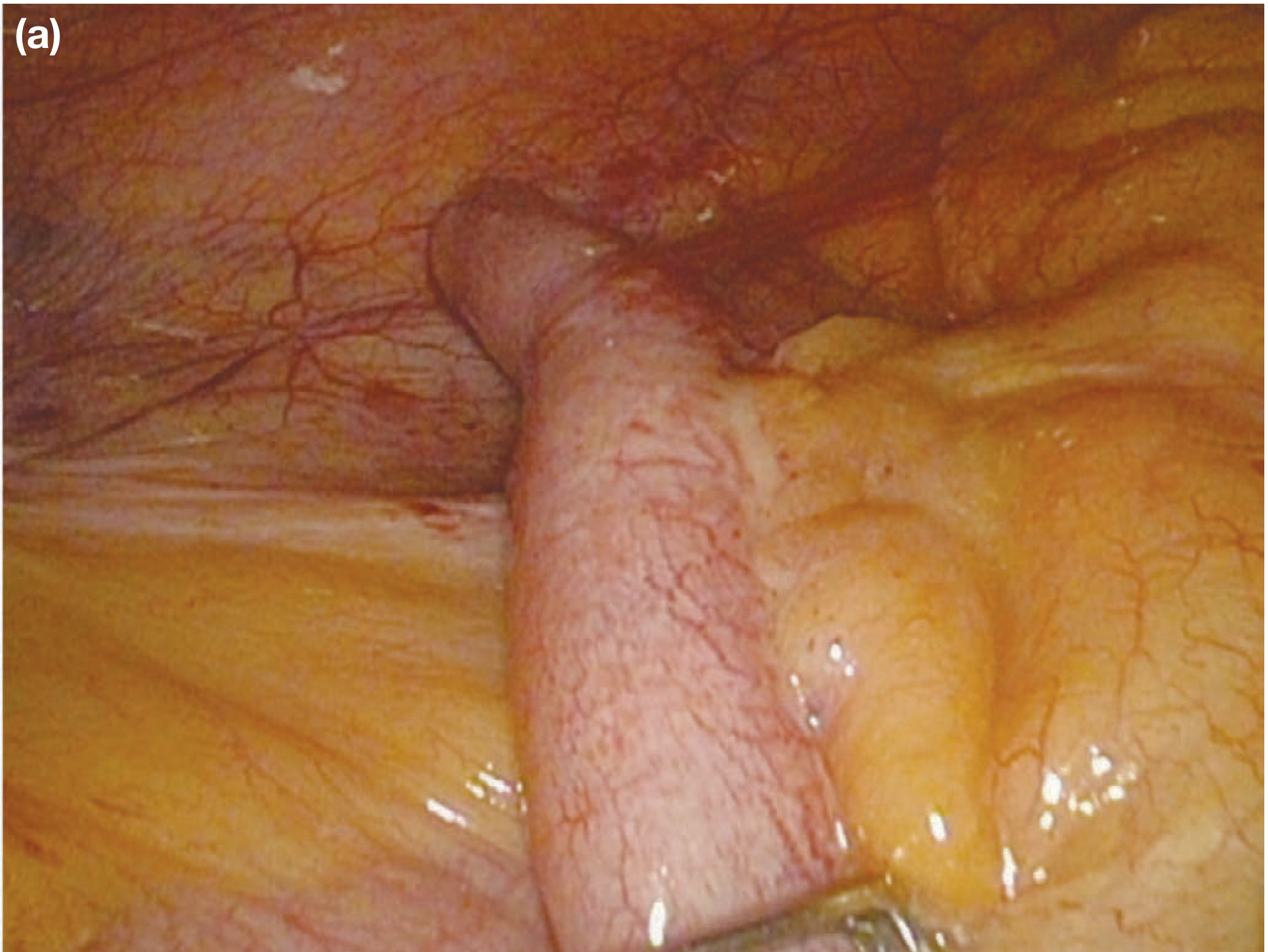 Acutely inflamed appendix with purulent exudate as seen at laparoscopy
