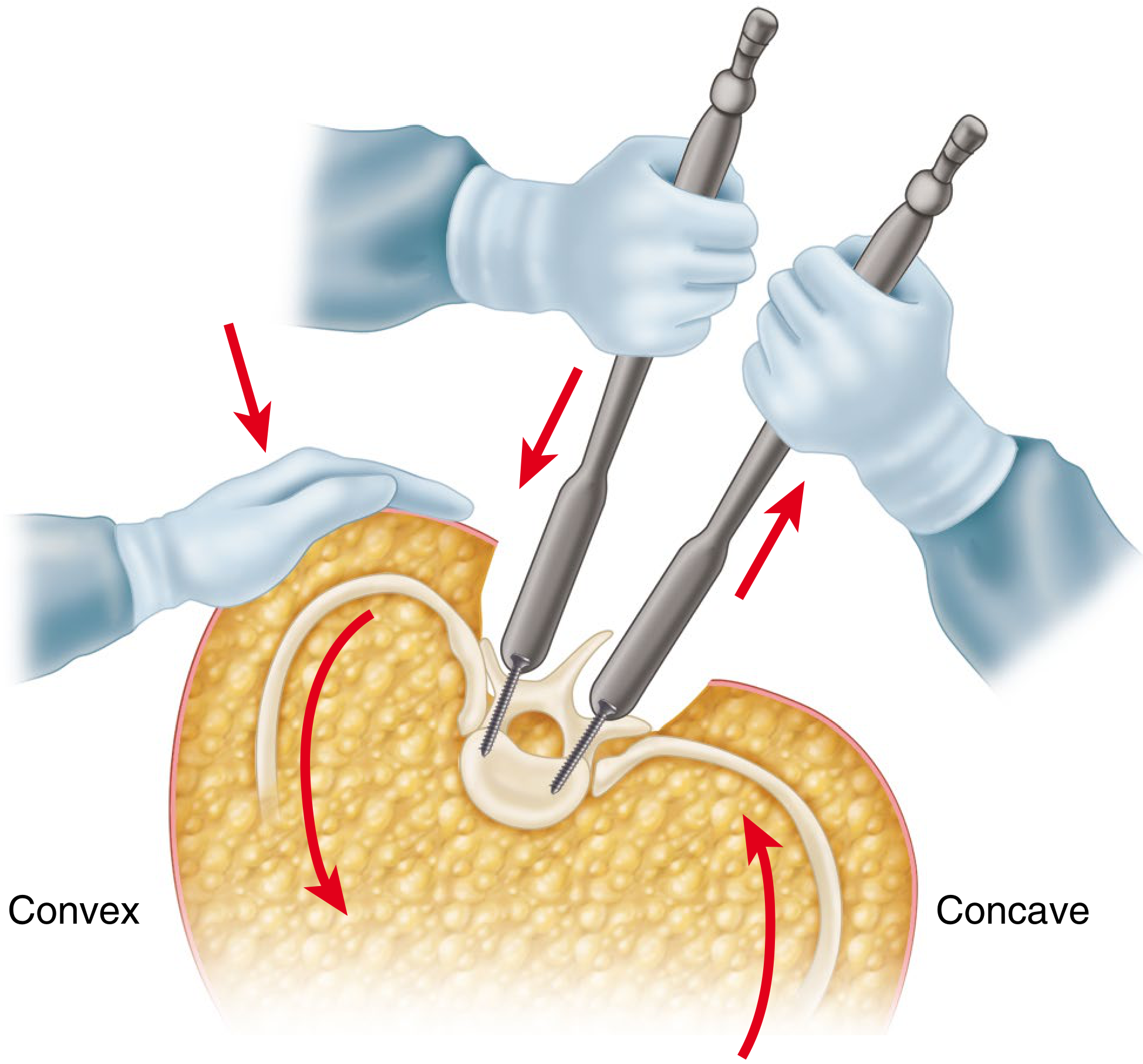 Direct Vertebral Rotation - Campbell's Operative Orthopaedics