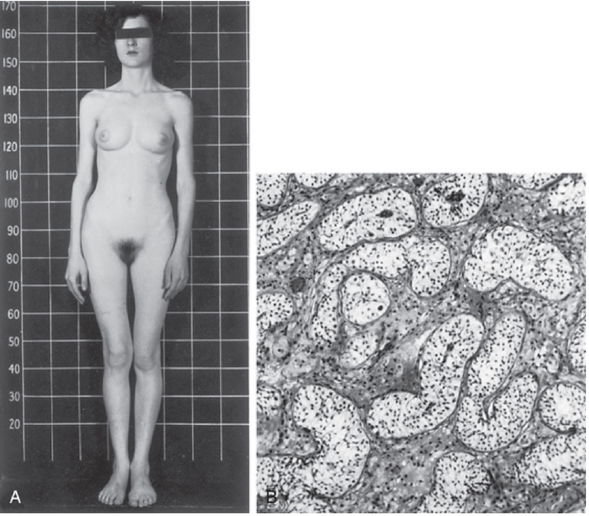 17-year-old woman with AIS — female phenotype with 46,XY karyotype and testes in inguinal region