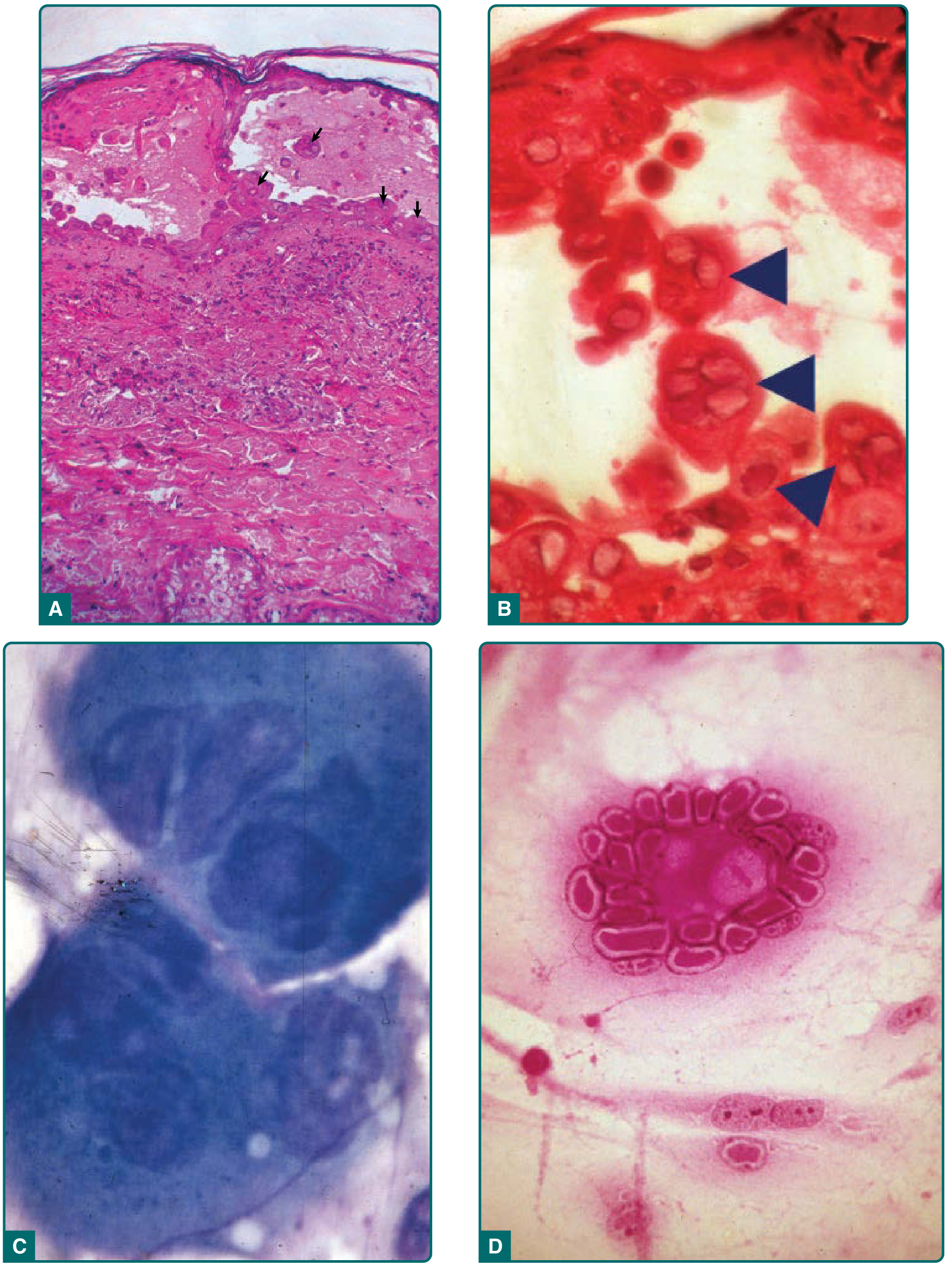 VZV/HSV histopathology: A) Intraepidermal vesicle with multinucleated giant cells (H&E ×100), B) Eosinophilic intranuclear inclusion bodies (arrowheads), C) Tzanck smear showing multinucleated giant cells, D) Viral inclusion bodies in cell culture