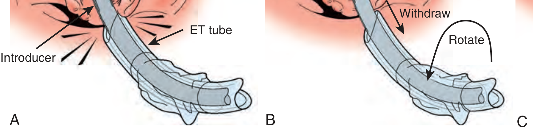 ETT railroading over introducer and arytenoid hang-up correction