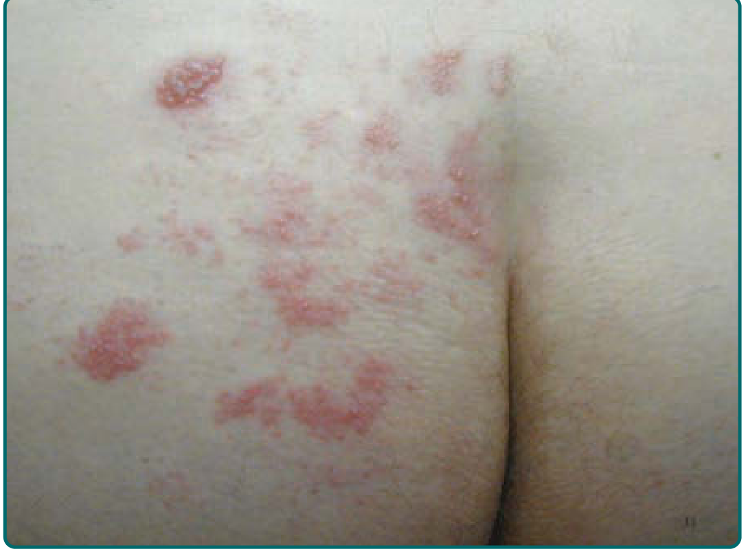 Herpes zoster - zosteriform clustered vesicular lesions on buttock