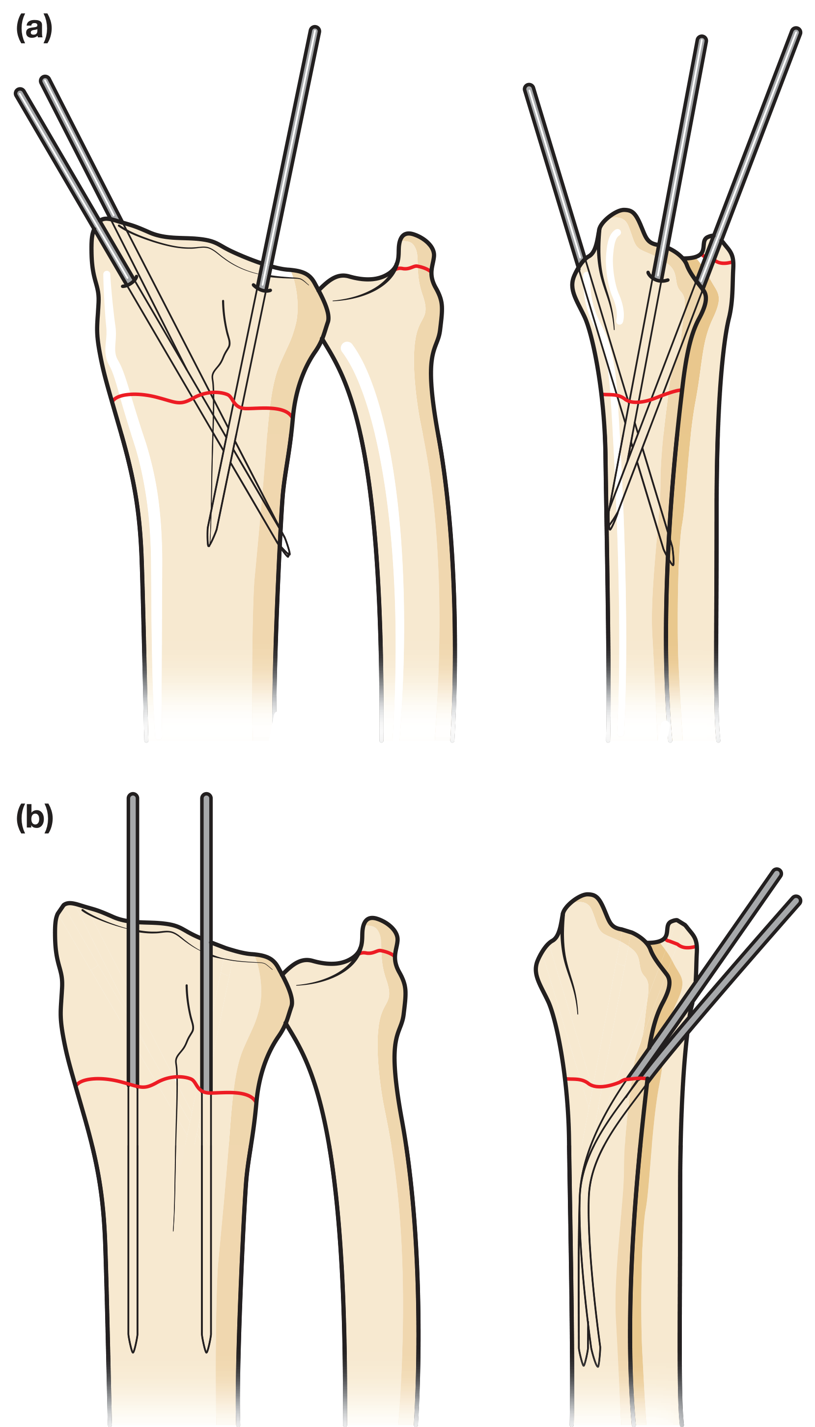 K-wire placement diagrams showing (a) wires placed across fracture fragments vs (b) intrafocal K-wires inserted into the fracture site used to lever and reduce the fracture