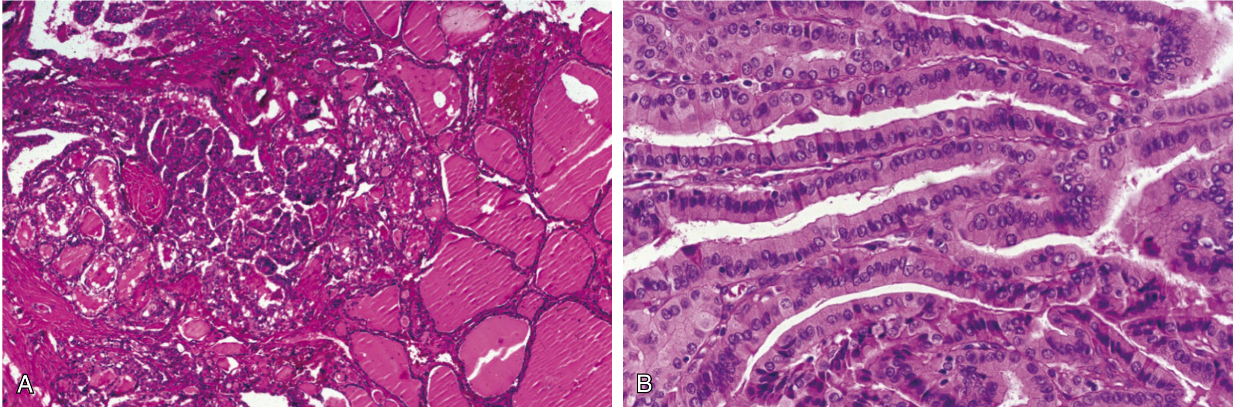 PTC histology (H&E) and tall cell variant - Sabiston