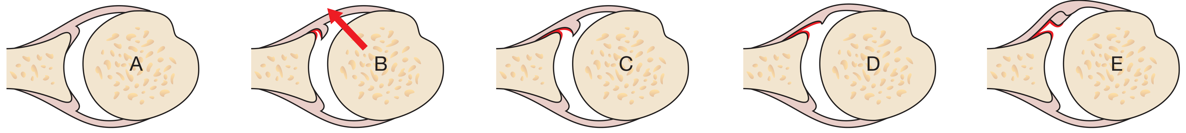 Bankart lesion spectrum