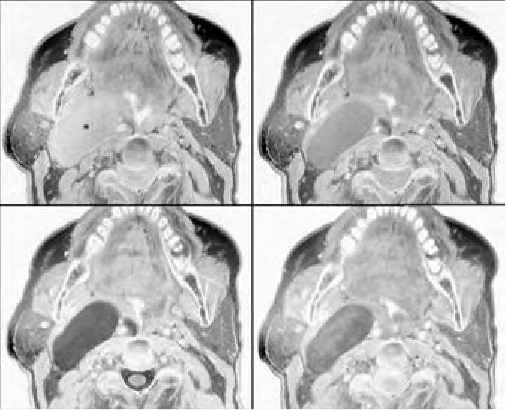Four MRI sequences of a parapharyngeal mass: T1WI (dark mass, dark CSF), spin density, T2WI (bright mass, bright CSF), and post-gadolinium T1WI (enhancing mass)