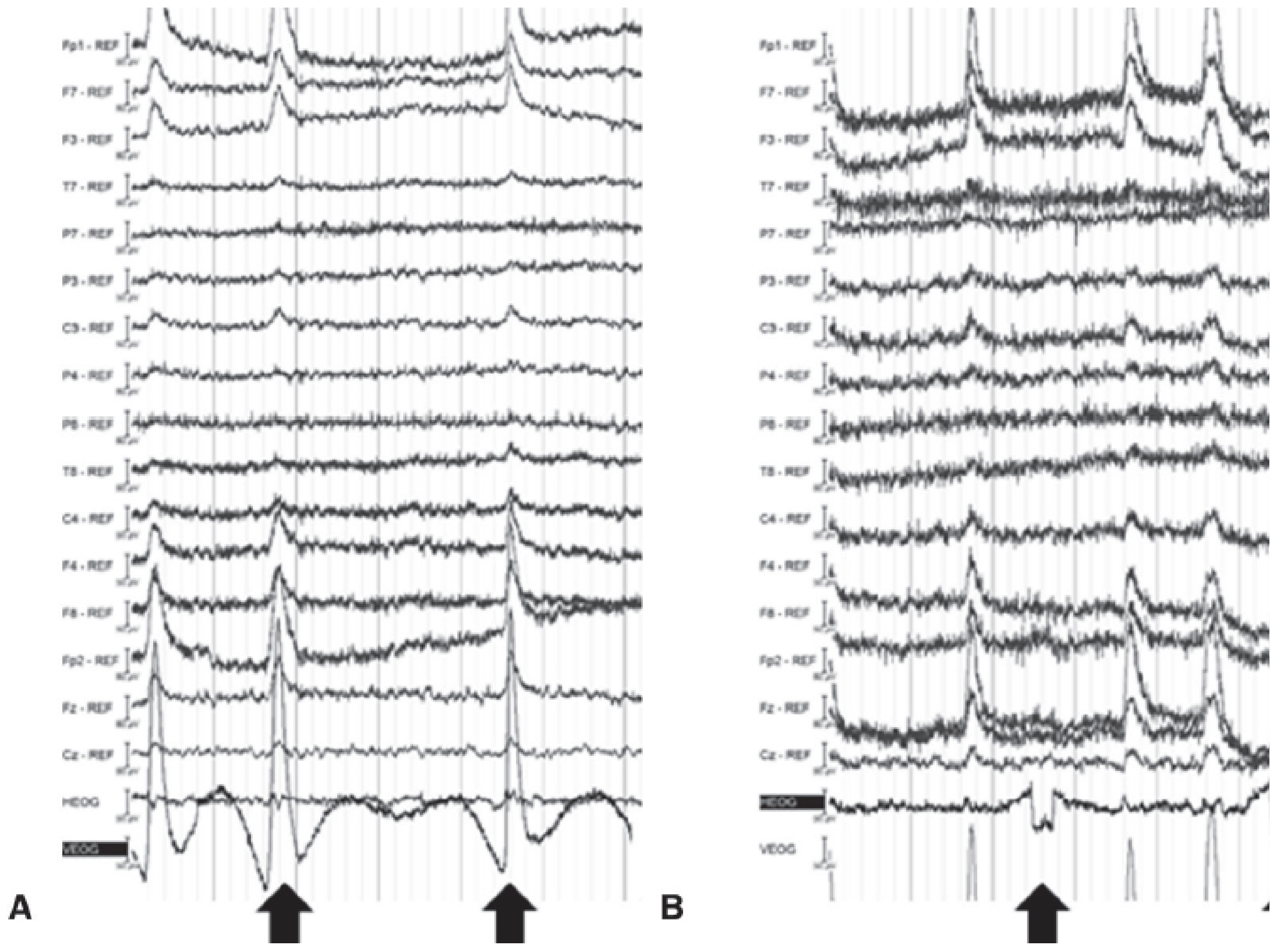 Vertical and horizontal eye-movement artifact