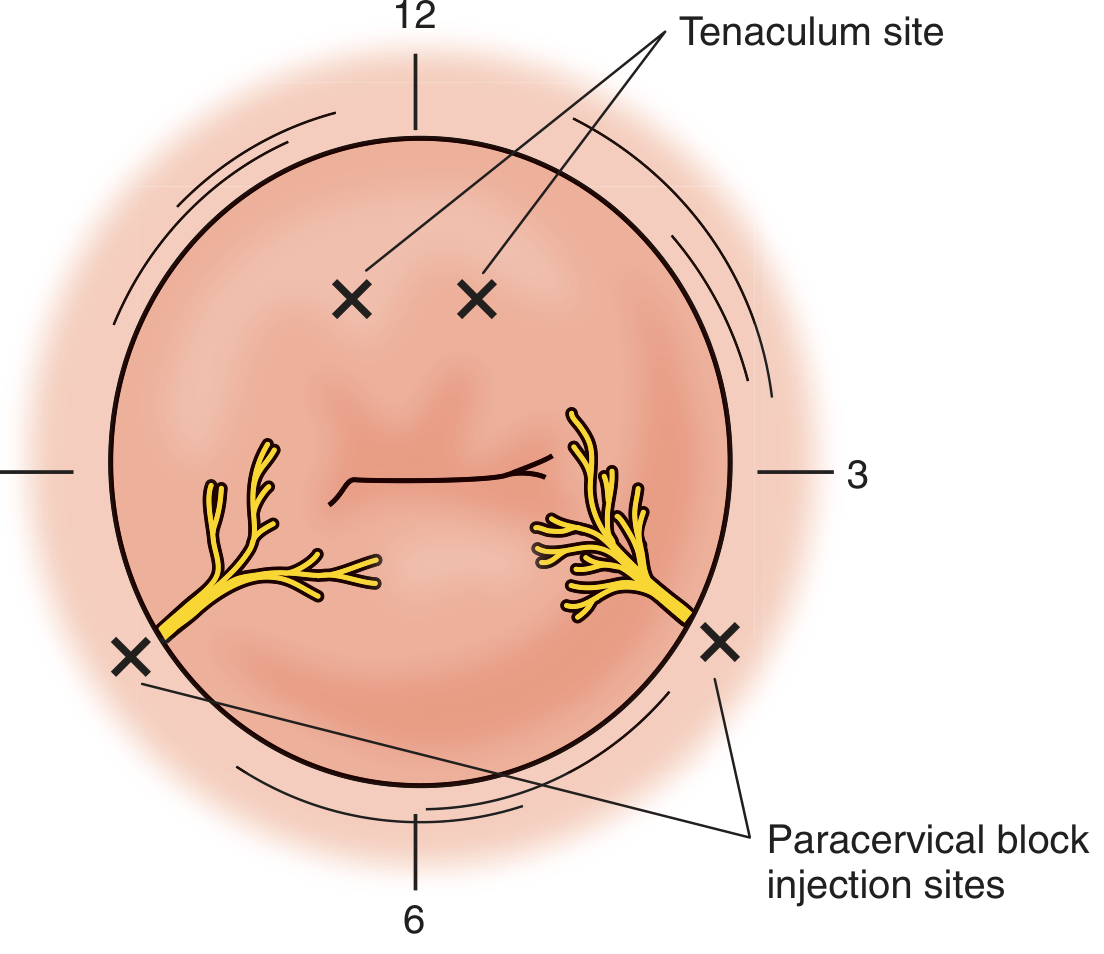 Paracervical block injection sites at 4 and 8 o'clock positions on the cervix, with tenaculum site shown, and Frankenhauser ganglion nerves visible laterally