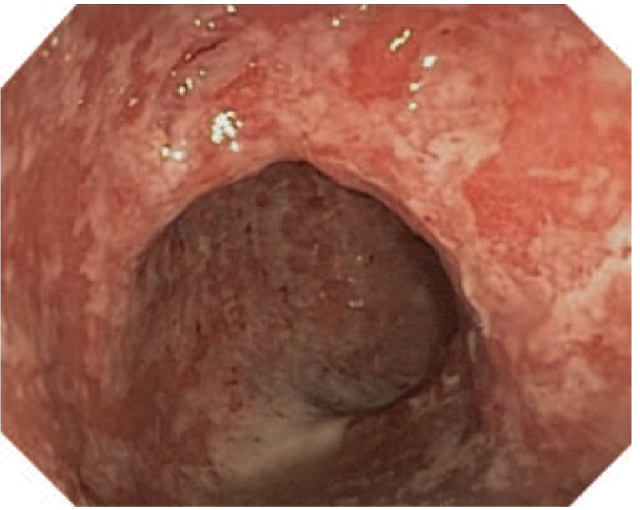 UC Colonoscopy