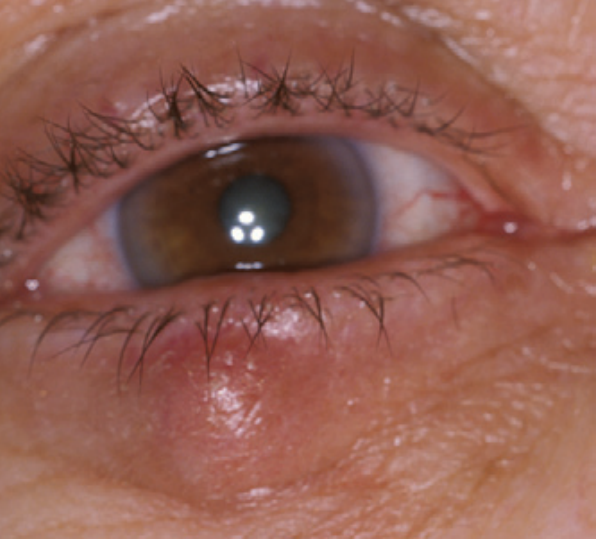 Chalazion of the lower eyelid
