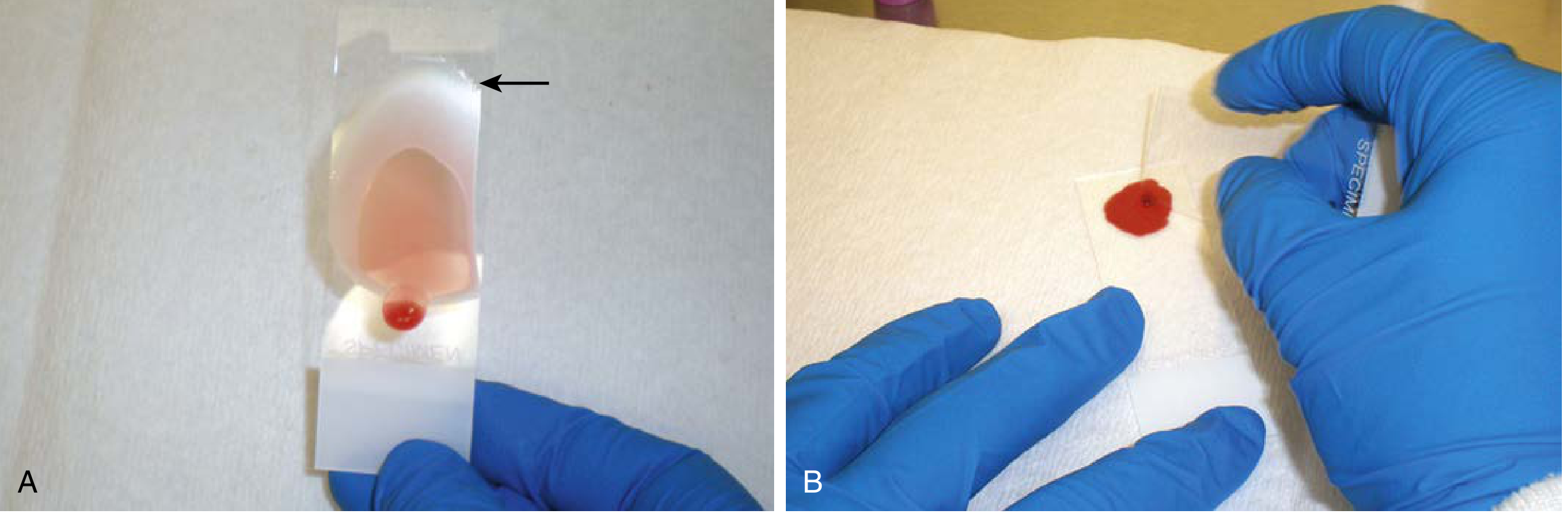 Thin blood film (A) showing the broad feathered edge (arrow) and thick blood film preparation (B)
