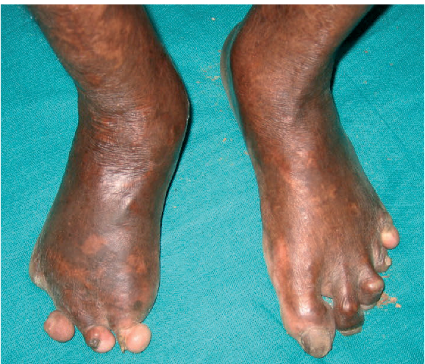 Claw toes from involvement of the posterior tibial nerve; note autoamputation of toes of the right foot