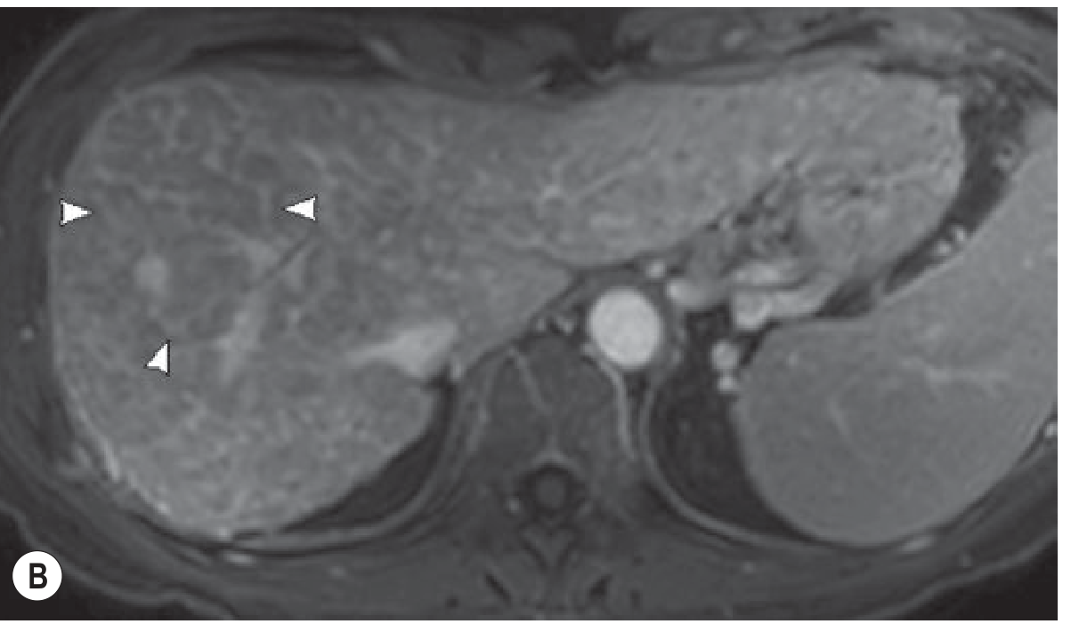 In-phase gradient echo T1W showing shrunken nodular liver with profoundly low parenchymal signal - liver darker than adjacent muscle, confirming severe iron overload