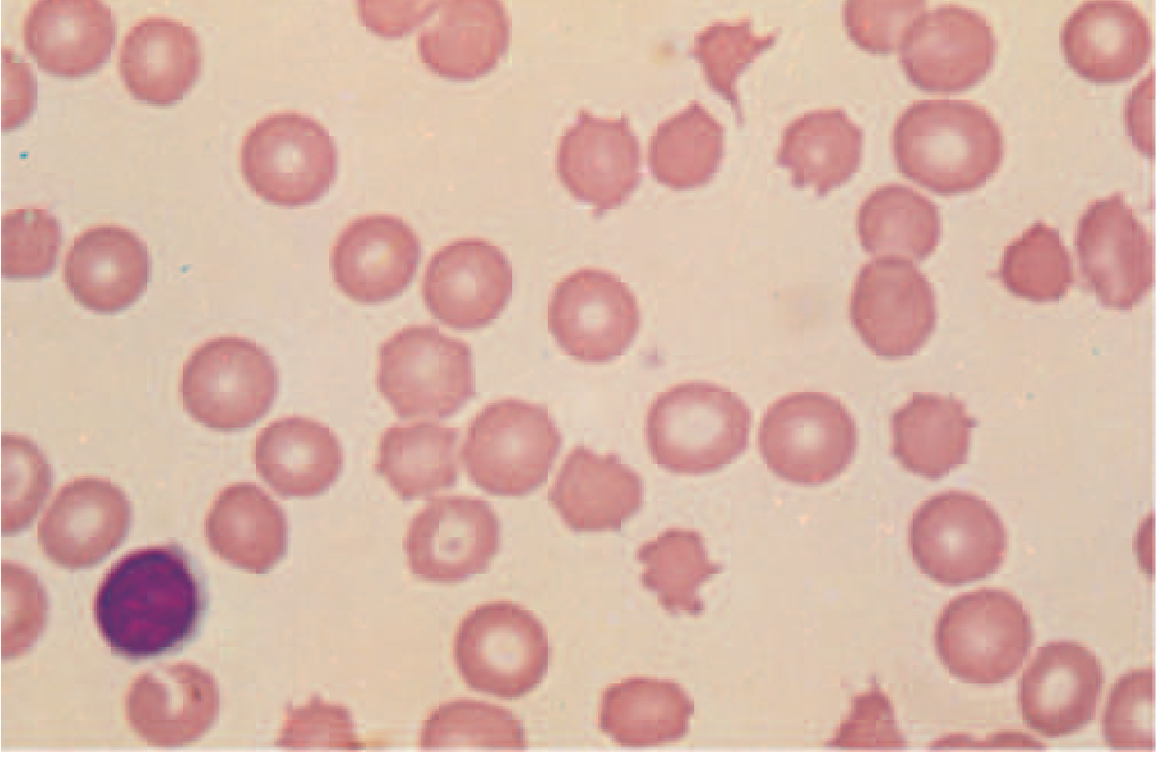 Spur cells on peripheral blood smear - distorted red cells with irregularly distributed thorn-like projections (acanthocytes)