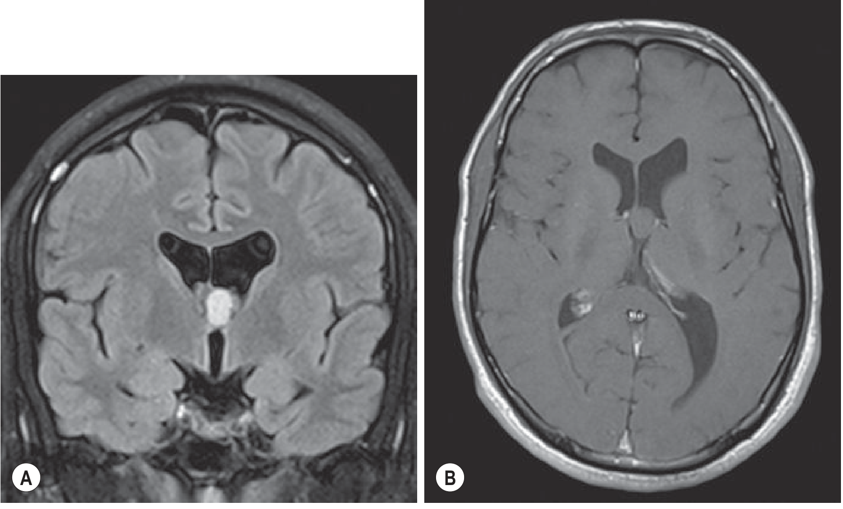 Colloid Cyst - FLAIR (A) shows a well-circumscribed homogeneously hyperintense mass at the foramen of Monro; post-contrast T1 (B) shows no enhancement, with mild left lateral ventricle dilation
