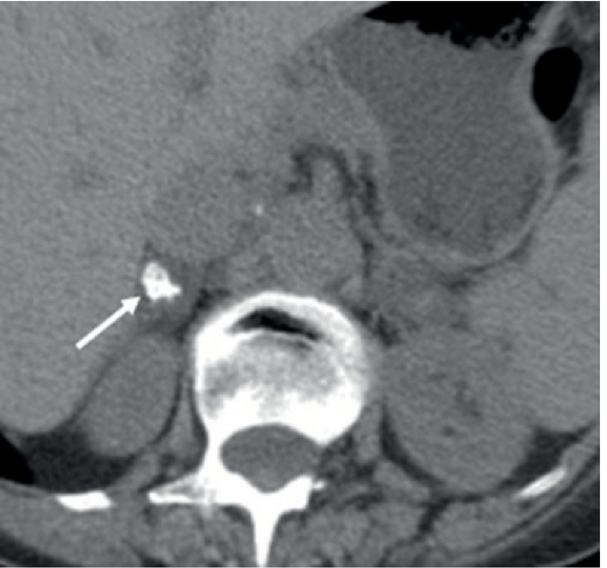 Unenhanced CT showing bilateral adrenal enlargement with focal calcification (right adrenal, arrow) in a patient with active tuberculosis