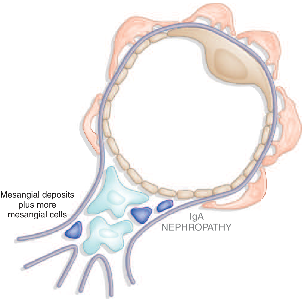 IgA nephropathy schematic showing mesangial deposits and increased mesangial cells