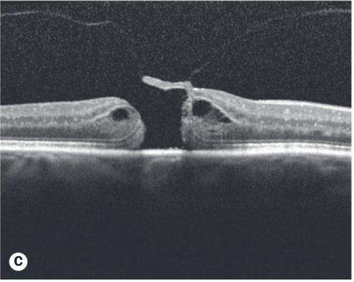 Kanski OCT FTMH with cysts and pseudo-operculum