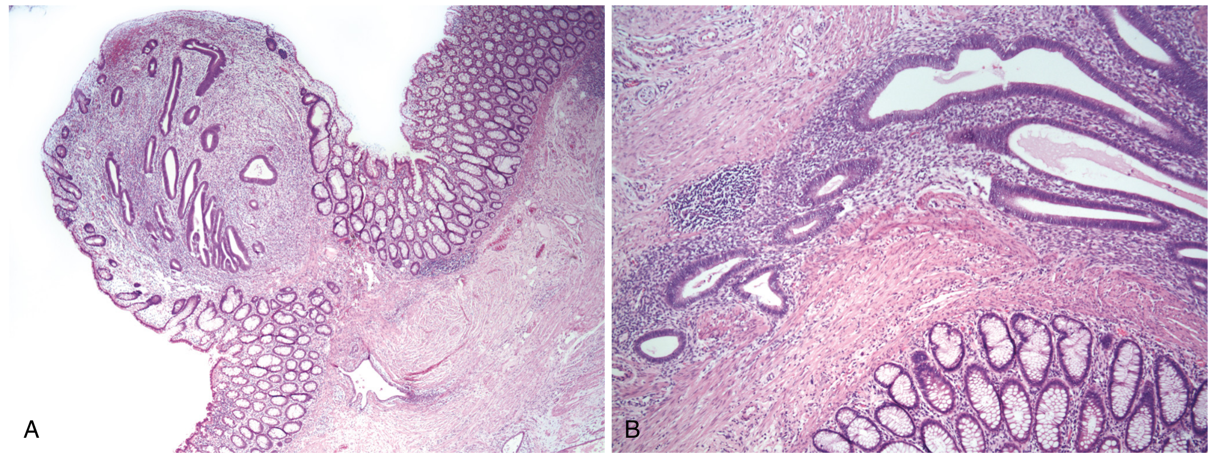 Endometriosis involving colon mucosa - showing endometrial glands and stroma adjacent to normal colonic mucosa (H&E stain, Robbins)