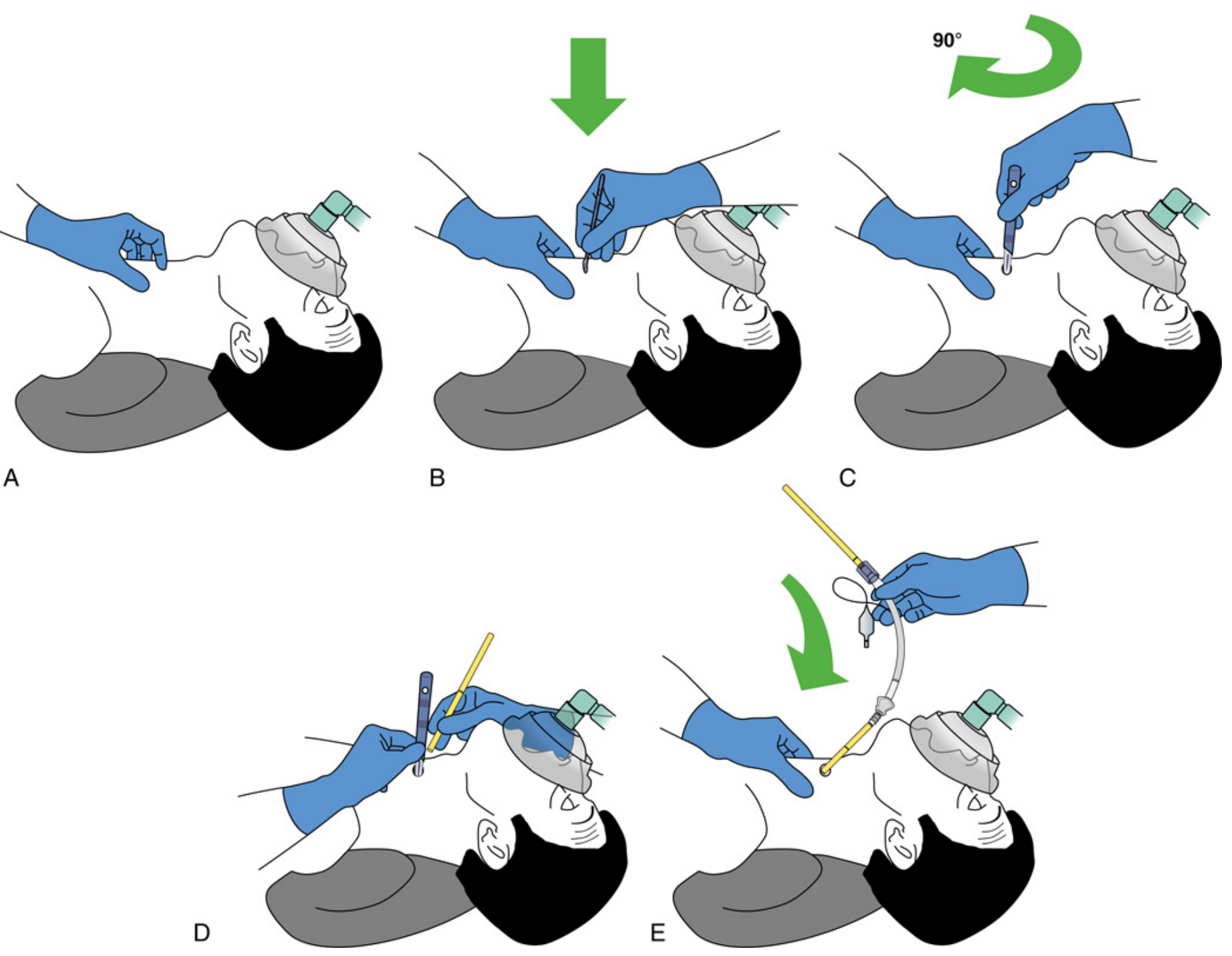 Scalpel-bougie technique - stab, twist, bougie, tube